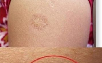 Svi rođeni u Jugoslaviji imaju ovaj ožiljak na ruci: Znate li kako je nastao i zbog čega?