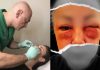 Dr. Siručić o deformisanom Azrinom licu: Bila je informisana o rizicima, otok se trebao sanirati na vrijeme - featured image
