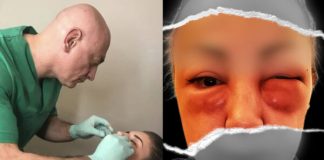 Dr. Siručić o deformisanom Azrinom licu: Bila je informisana o rizicima, otok se trebao sanirati na vrijeme - featured image