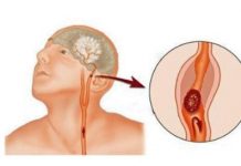 Simptomi moždanog udara kod žena - featured image