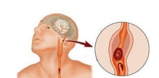 Simptomi moždanog udara kod žena - featured image