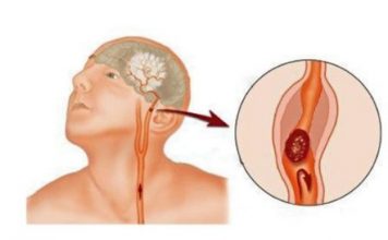 Simptomi moždanog udara kod žena - featured image