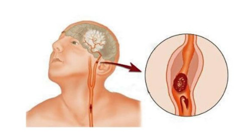 Simptomi moždanog udara kod žena - featured image Simptomi moždanog udara kod žena - featured image