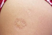 Ako ste rođeni u SFRJ, imate ožiljak od vakcine na ramenu. Znate li zašto se stvorio taj ožiljak? OBJAŠNJENJE. (VIDEO) - featured image