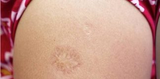 Ako ste rođeni u SFRJ, imate ožiljak od vakcine na ramenu. Znate li zašto se stvorio taj ožiljak? OBJAŠNJENJE. (VIDEO) - featured image