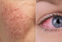 12 ranih znakova da vaše tijelo pokušava reći da vam je JETRA OŠTEĆENA. - featured image