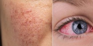 12 ranih znakova da vaše tijelo pokušava reći da vam je JETRA OŠTEĆENA. - featured image