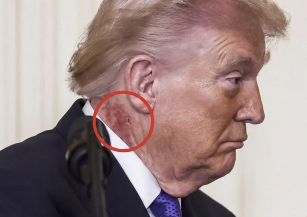 Širi se fotografija crvene mrlje na Trumpovom vratu. Javila se Bijela kuća - featured image